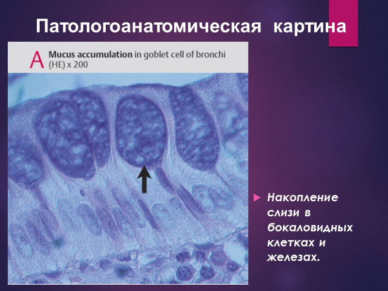 Накопление слизи в бокаловидных клетках и железах. Патологоанатомическая  картина